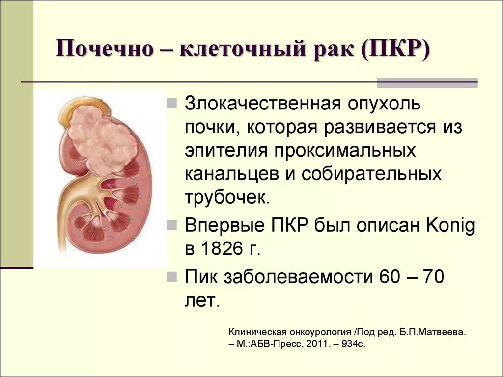 Опухоли почки этиология классификация. Опухоль почечной лоханки. Злокачественные опухоли паренхимы почки. Почечно-клеточная карцинома почки. Рак почки причины