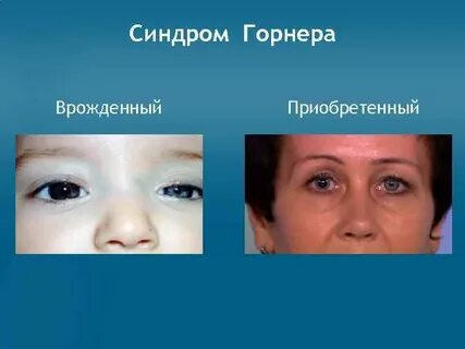 Синдром бернара