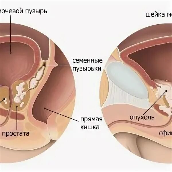 Склероз шейки мочевого пузыря. Склероз шейки мочевого пузыр. Тур склероза шейки мочевого пузыря. Склероз простаты и шейки мочевого пузыря. Операция шейки мочевого пузыря