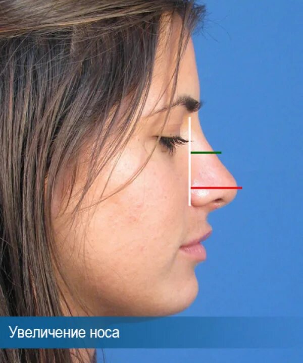 Рост носа в год. Маленький нос. Коррекция носа противопоказания.