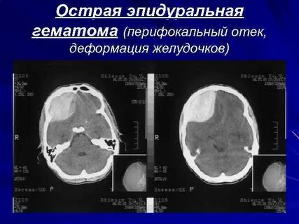 Перифокальный это