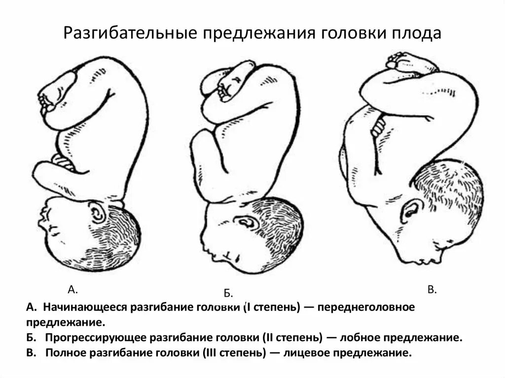 Положения головки плода. Продольное головное предлежание плода. Головное предлежание плода лицевое. Предлежание положение и позиция плода. Головное предлежание продольное положение 1 позиция.