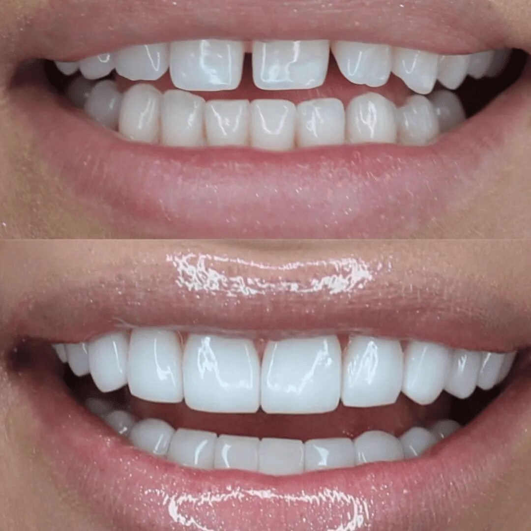 Что стоит знать о винирах в 2025? Ответ экспертов! New Smile Clinic Дзен