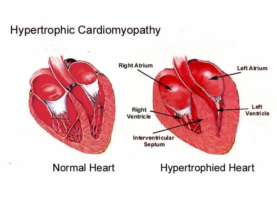 Миокард латынь. Гипертрофированный миокард левого желудочка. Сердце кошки гипертрофическая кардиомиопатия. Нормальное и гипертрофированное сердце.