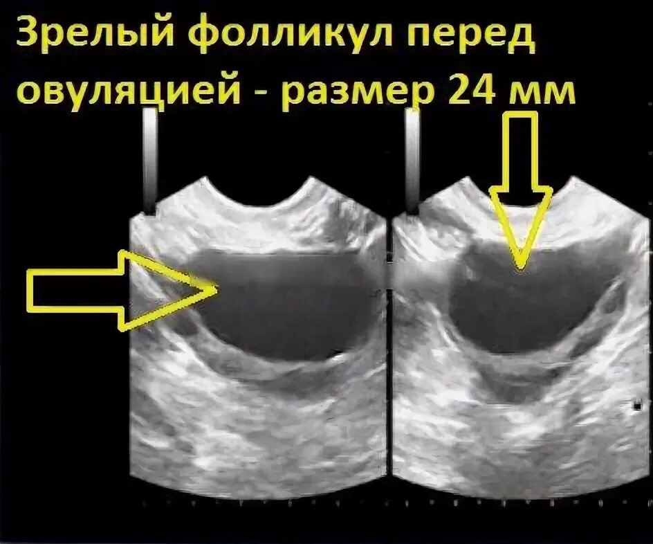 Сколько фолликулов должно быть в яичнике