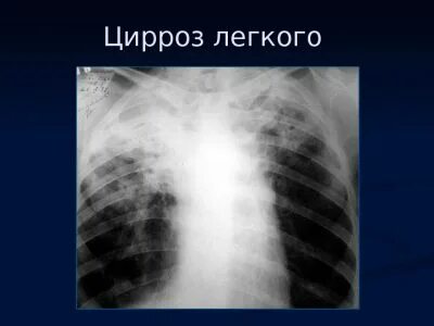 Цирроз легкого