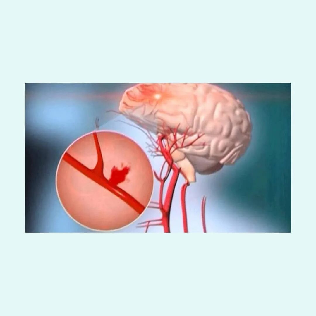 Геморрагический инсульт. Геморрагический инсульт кровоизлияние в мозг. Геморрагический инсульт снимки. Геморрагический инсульт картинки.