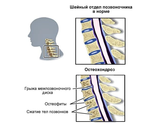 Шейный остеохондроз позвонки шейного отдела. Дорсопатия шейного отдела позвоночника. Шейный отдел позвоночника при хондрозе. Шейный остеохондроз отде.