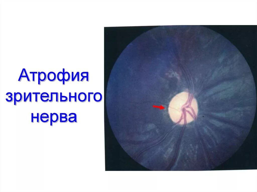 Атрофия зрительного нерва у детей. Нейропатия зрительного нерва Лебера. Атрофия зрительного нерва офтальмоскопия. Наследственная оптическая нейропатия Лебера.