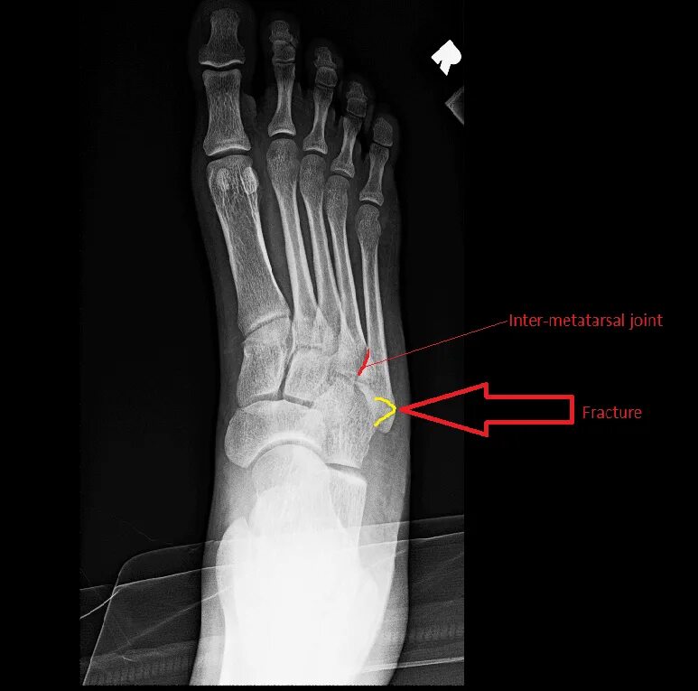 Перелом кости стопы сколько заживает у взрослых. Перелом Джонса плюсневой кости. Рентген 5 плюсневой кости стопы. Перелом Джонса 5 плюсневой. Перелом Джонса 5 плюсневой кости.