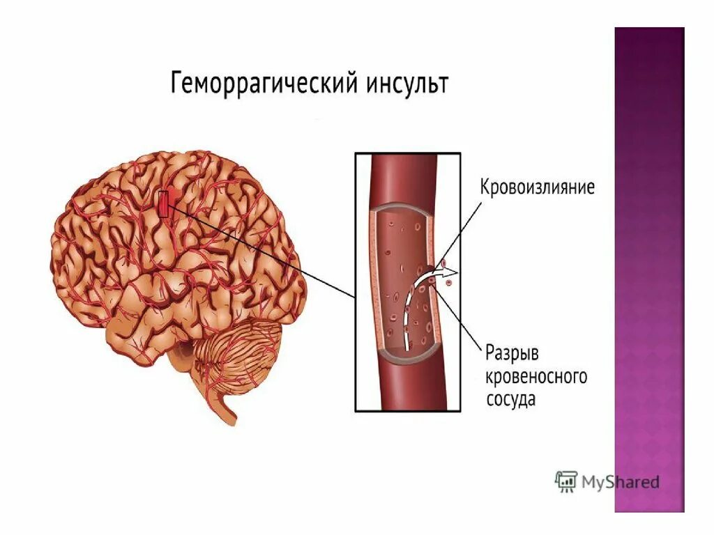 Геморрагический инсульт разрыв сосуда. ОНМК геморрагический инсульт. ОНМК ишемический и геморрагический инсульт. Геморрагический инсульт при гипертонической болезни.