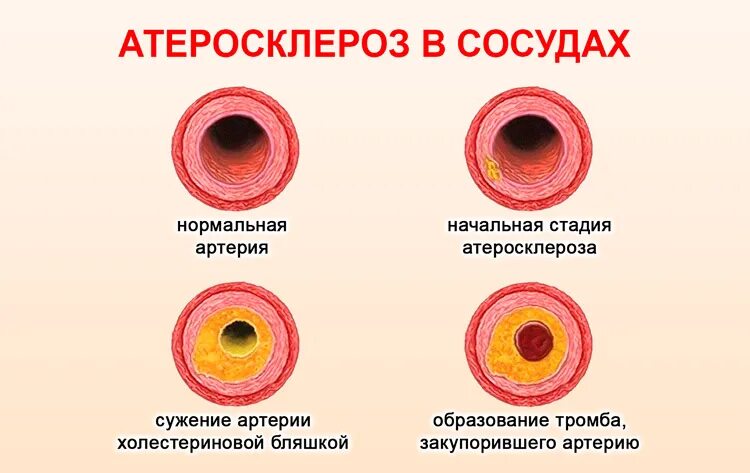 Атеросклеротические изменения сосудов. Атеросклеротическая болезнь сосудов. Атеросклероз бляшки сосудов. Атеросклероз (закупорка кровеносных сосудов). Схема изменений сосудистой стенки при гипертонической болезни.