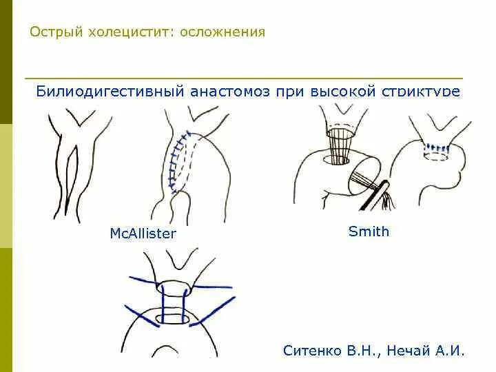 Билиодигестивный анастомоз по Микуличу. Билиодигестивный анастомоз схема. Билиодигестивный анастомоз по Флеркену. Билиодегистивный анастамоз. Острый холецистит тесты с ответами