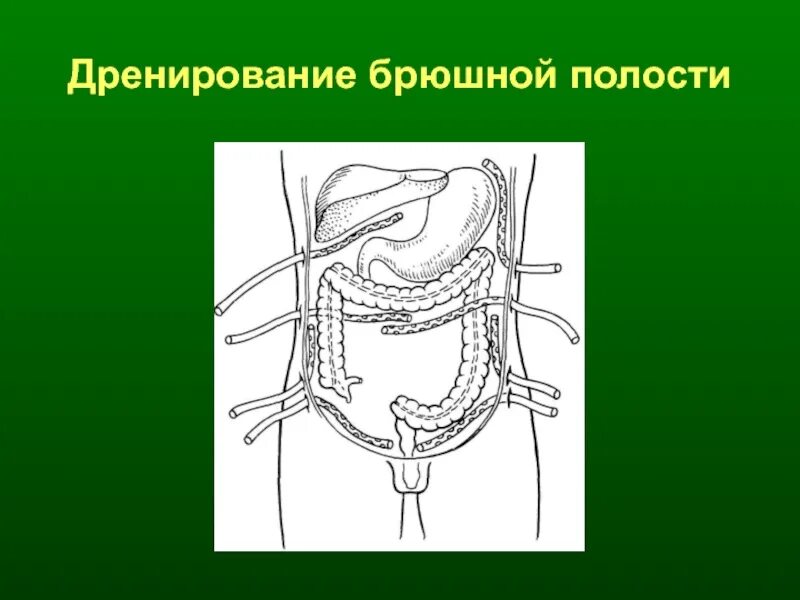 Что такое санация кишечника. Транскутанное дренирование внутрибрюшных абсцессов. Адекватное дренирование гнойника. Дренирование по Генералову техника.