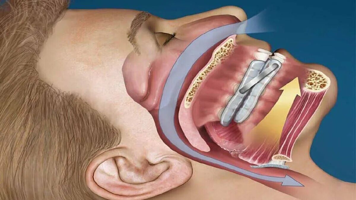 Почему появляется храп