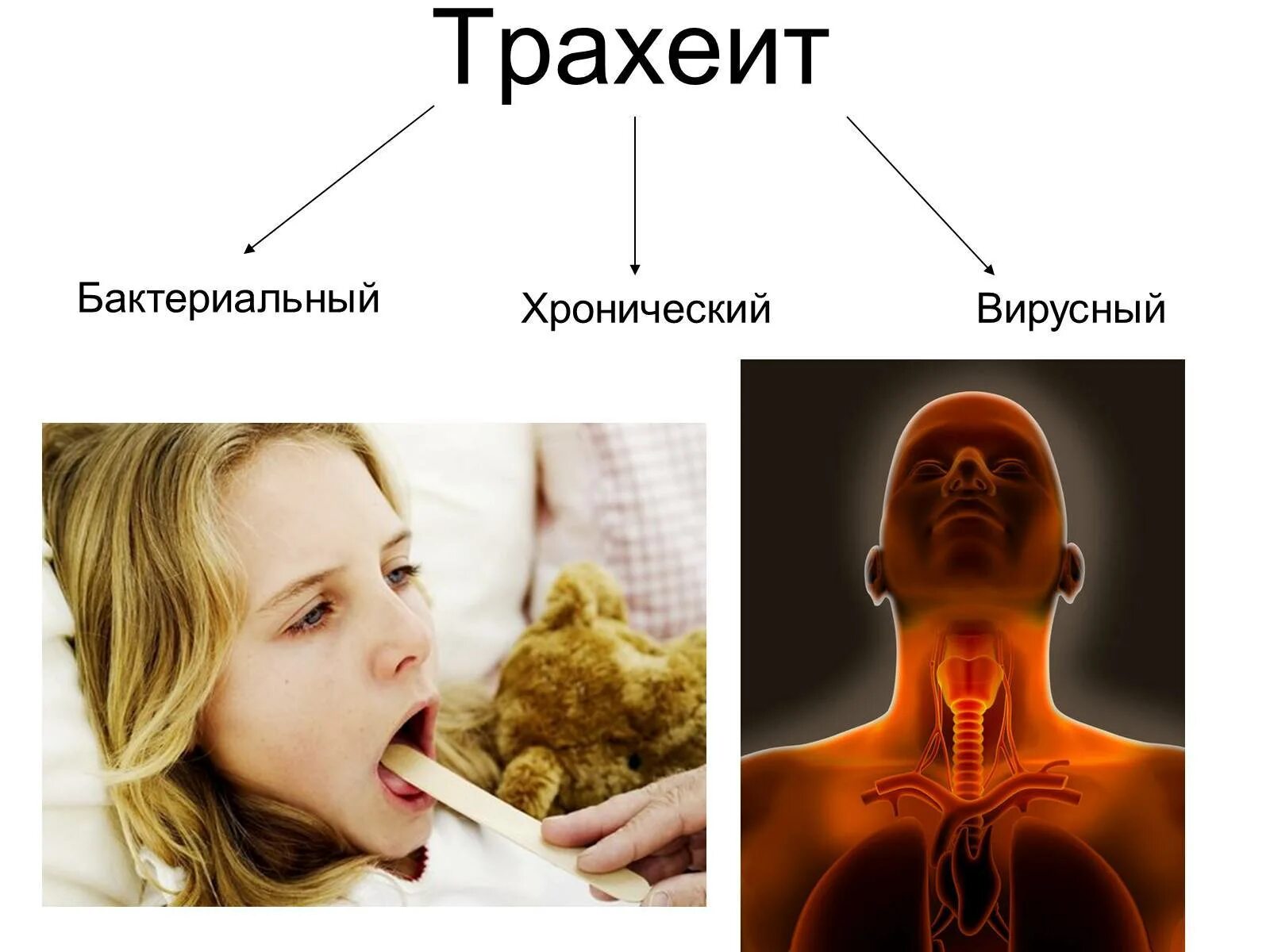 Вирусный трахеит симптомы