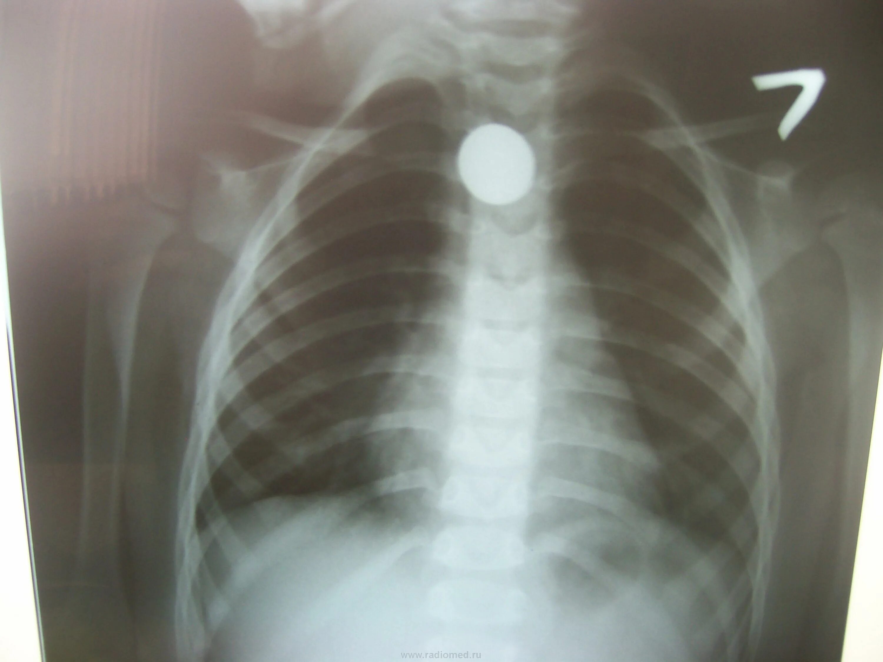 Тело пищевода. Инородное тело пищевода рентген. Инородное тело в дыхательных путях у ребенка рентген. Инородные предметы в легких. Инородные тела пищевода у детей.