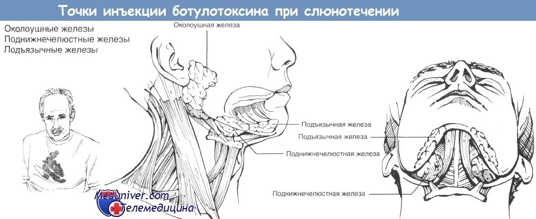 Точки инъекции ботулотоксина при мигрени. Ботулинотерапия мигрени схема. Ботокс при слюнотечении. Точки введения ботулотоксина при блефароспазме. Точка уколова