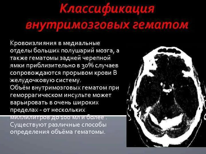 Внутримозговая гематома классификация кт. Субарахноидальное кровоизлияние патанатомия. Классификация внутримозговых кровоизлияний. Гематома мозга операция