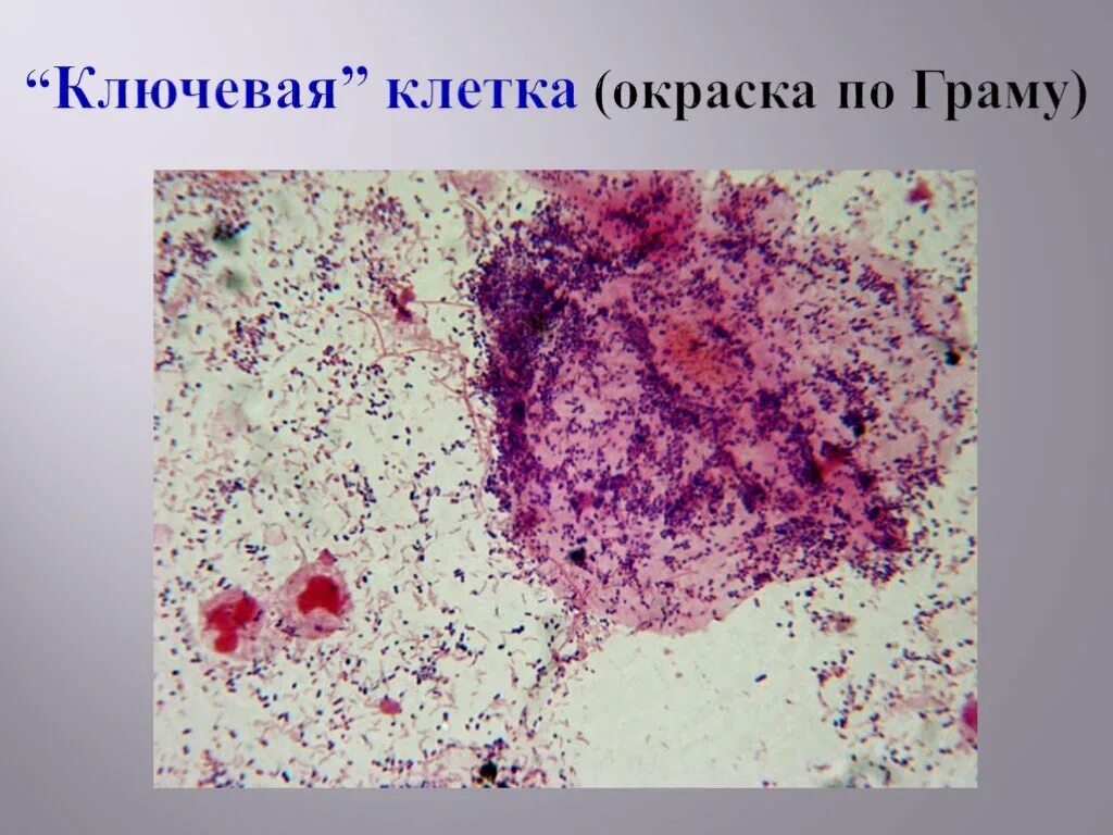 Микроорганизмы женских половых органов. Бактериальный вагиноз гарднереллёз. Бактериальный вагиноз мазок. Бактериальный вагиноз микроскопопия.