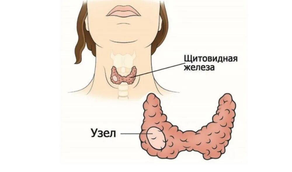 Щитовидная железа узлы правой доли