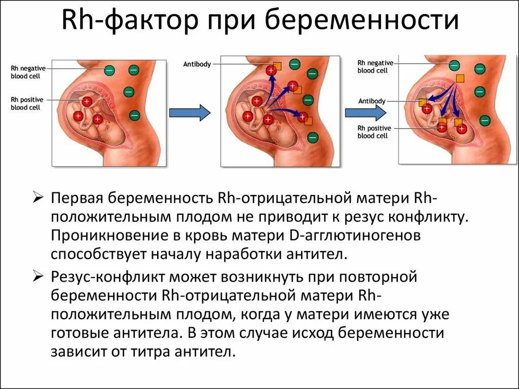 Резус фактор у беременных