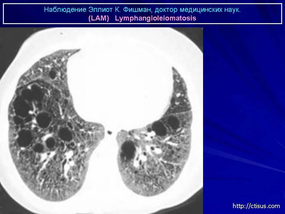 Пневмосклероз это простыми словами. Легочный лейомиоматоз. Лейомиоматоз кт. Лейомиоматоз легких клинические рекомендации. Лейомиоматоз легких на кт.