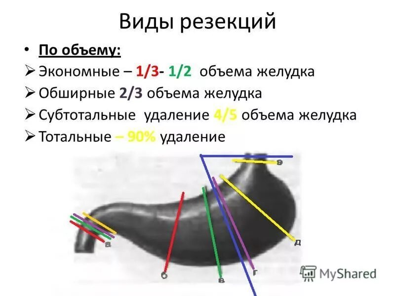 экономная резекция желудка. стволовая ваготомия с антрумэктомией. резекция желудка бильрот 1 модификации. резекция желудка с ваготомией. экономная резекция желудка.
