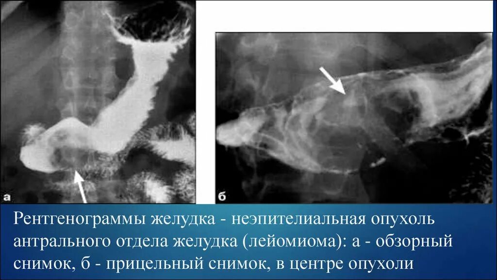 Пенистое содержимое. Опухоль антрального отдела желудка рентген. Раковая опухоль желудка рентген. Лейомиома желудка рентген.