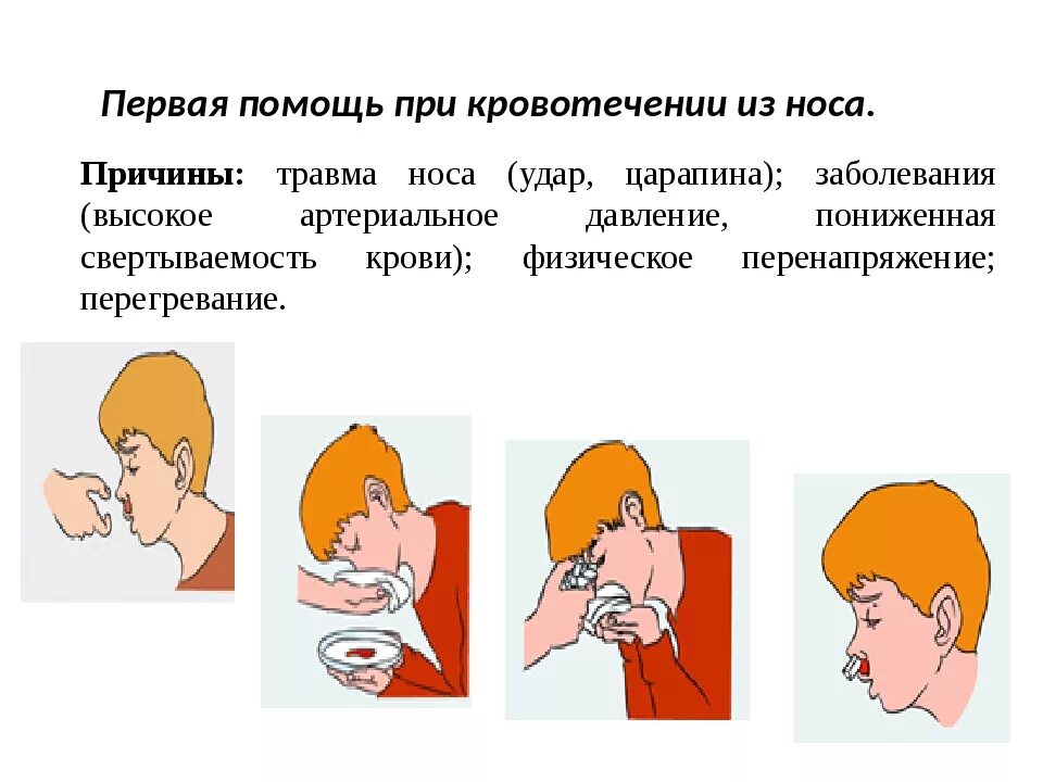 Оказание первой помощи при кровотечении из носа. Повязка при травматическом кровотечении из носа. Оказание первой помощи при травме носа. Первая помощь при кровотечении ИД роса.