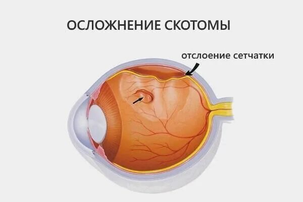 Регматогенная отслойка сетчатки глаза. Разрыв сетчатки лазерная коагуляция. Отслойка сетчатки макулярный разрыв. Регматогенная отслойка сетчатки симптомы.