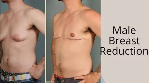 male breast reduction surgery, male breast reduction, more on male breast r...