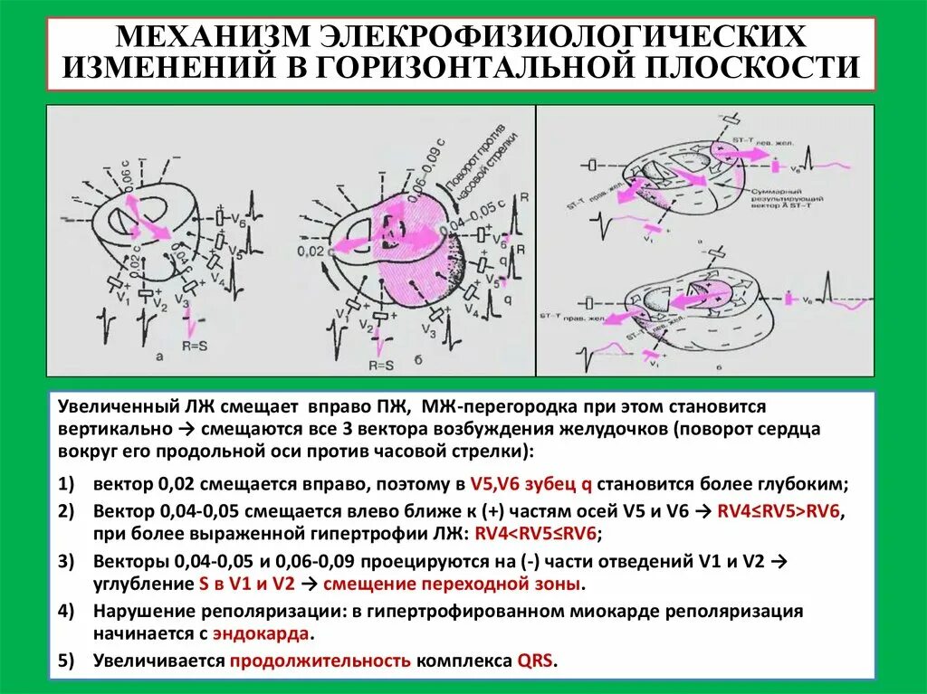 Определение поворотов сердца вокруг продольной оси. Поворот сердца против часовой. Векторы возбуждения миокарда желудочков. Поворот сердца вокруг продольной оси по часовой стрелке. Поворот правым желудочком вперед