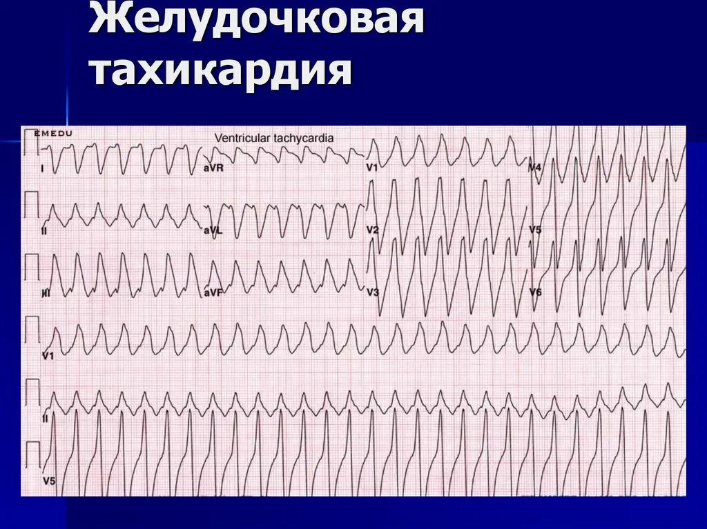 Желудочковая тахикардия на экг. Пароксизмальная желудочковая тахикардия на ЭКГ. Пароксизм желудочковой тахикардии ЭКГ. Веретенообразная желудочковая тахикардия ЭКГ.