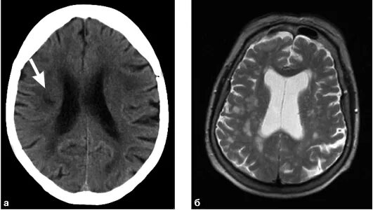 Дисциркуляторные изменения головного мозга что это такое. Дисциркуляторная энцефалопатия головного мозга на кт. Дисциркуляторная энцефалопатия мрт. Дэп мрт головного мозга. Энцефалопатия на кт.