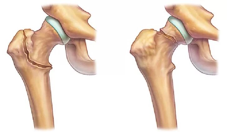 Вальгусный перелом шейки бедра. Несросшийся перелом шейки бедра. Чрезвертельный перелом шейки бедра. Внутрисуставной перелом шейки бедра. Шейка бедра лечение без операции