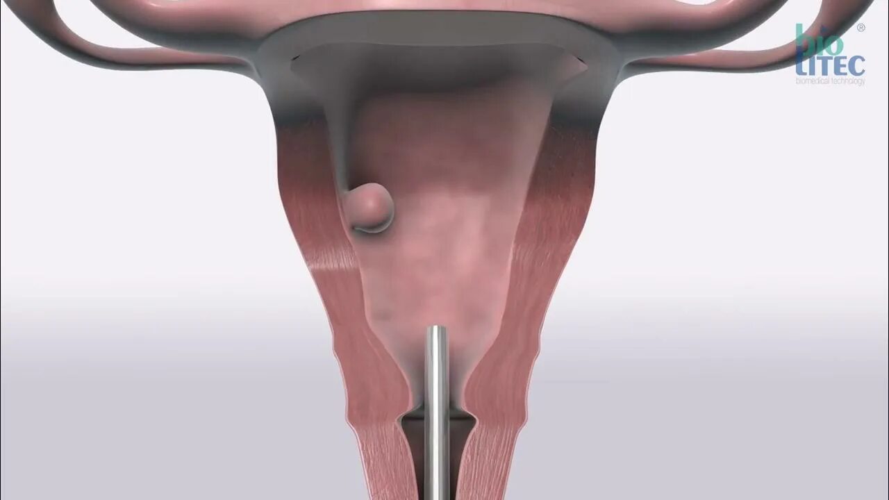 Гистероскопическая миомэктомия. Полип эндометрия гистероскопия. Миома матки гистероскопия операция. . Гистероскопия (субмукозные узлы)..