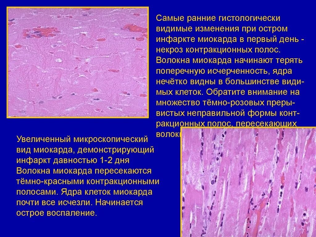 Миокард латынь. Инфаркт ишемический миокарда микропрепарата. Препарат острый инфаркт миокарда гистология. Атеросклероз аорты патанатомия микропрепарат. Острый инфаркт миокарда препарат патанатомия.