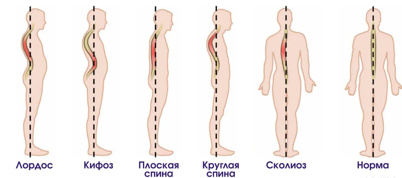 Лордоз поясничного отдела позвоночника. Физиологический лордоз. Сглаженный лордоз. Лордоз и кифоз позвоночника. Щенок по имени лордоз