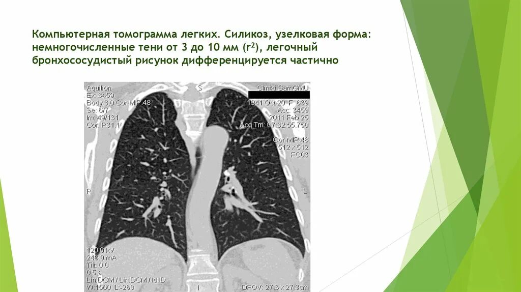 Клинические проявления силикоза. Силикоз легких что это симптомы лечение. Силикоз легких что это симптомы лечение. Силикоз узелковая макропрепарат. Силикоз легких что это симптомы лечение.