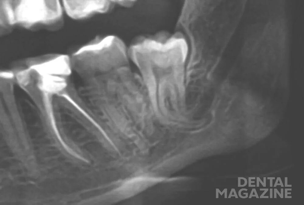 Зуб 8 нижний. Корни 8 зуба в нижнечелюстном канале. Нижнечелюстной канал на рентгене. Проталкивание корня зуба в нижнечелюстной канал. Корни зубов верхней челюсти рентген.