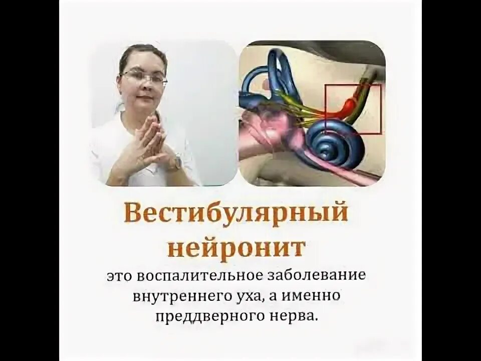 Вестибулярный нейронит симптомы и лечение. Вестибулярный нейронит симптомы. вестибулярный нейронит клинические рекомендации. нейронит вестибулярного аппарата. вестибулярный нейронит дифференциальная диагностика.