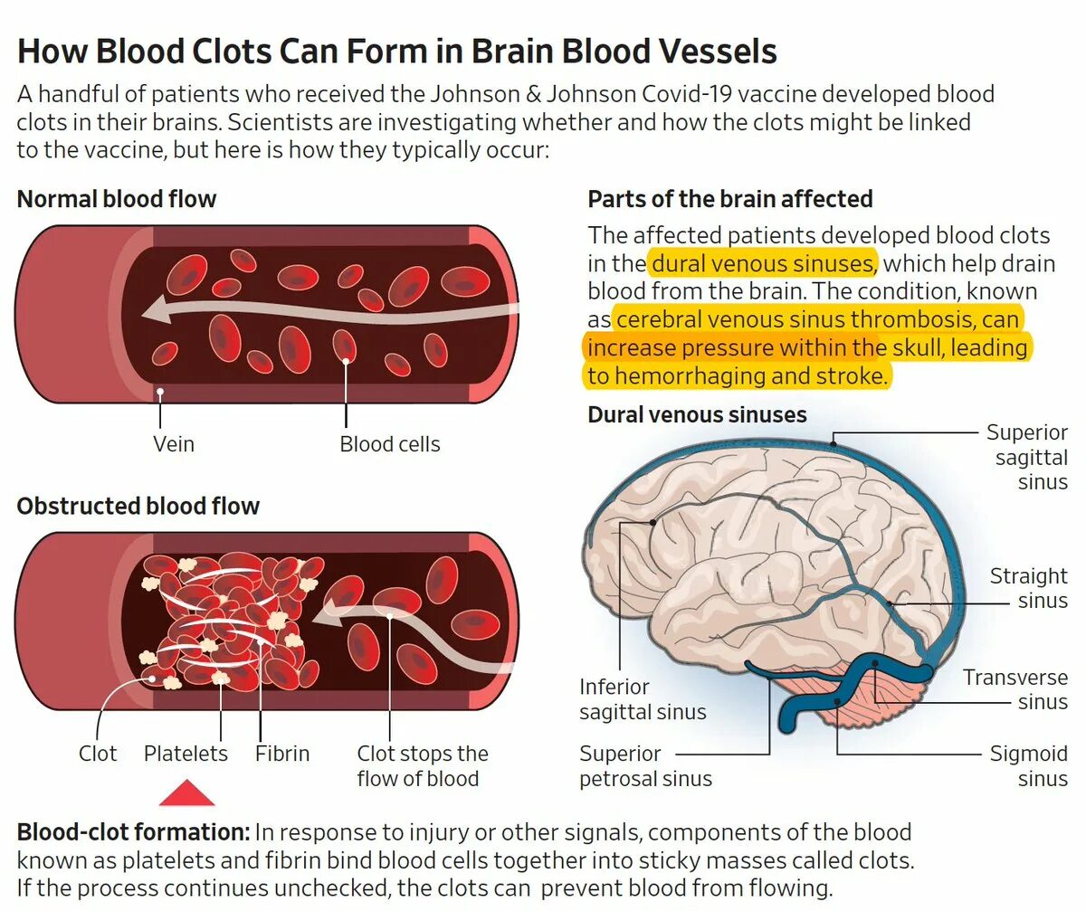 Имеет крови мозга и. Cerebral venous Sinus Thrombosis treatment.