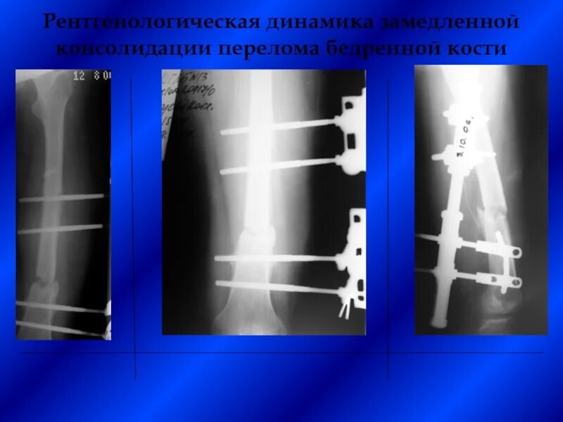 Что такое консолидация перелома. Перелом диафиза бедра рентген. Консолидированный перелом бедренной кости рентген. Перелом диафиза бедренной кости. Консолидированный перелом диафиза бедренной кости рентген.