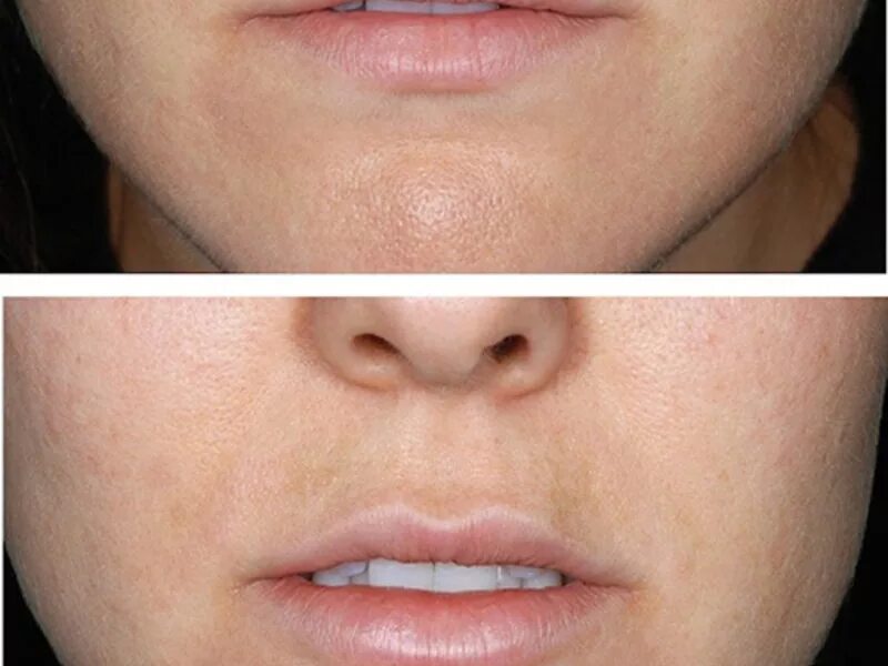 увеличение тонких губ 1 мл. аугментации губ тонкие губы 1 мл. шубы после контурной пластики. увеличение губ до и после. гиалуроновая кислота в губы.