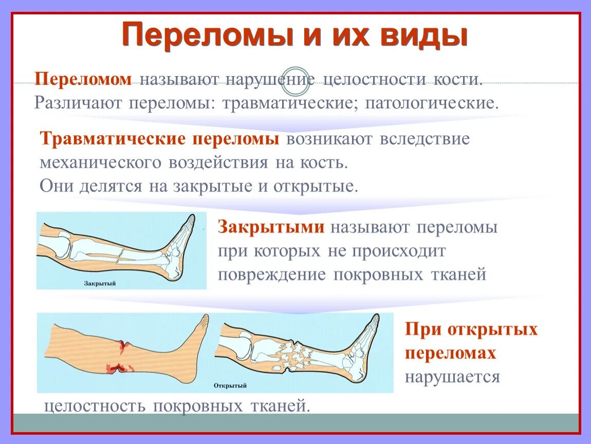 Степени открытого перелома. Переломы костей презентация.