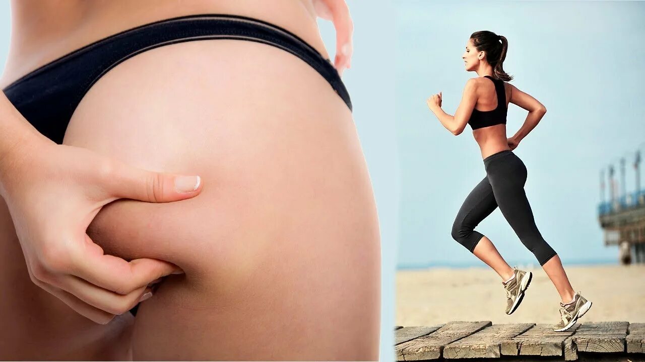 Как убрать целлюлит у женщин. Как убрать целлюлит у женщин. Целлюлит второй степени. Макронодулярный целлюлит. Липодистрофия целлюлит.