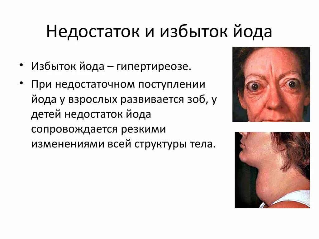 Чем грозит переизбыток. При избытке йода в организме симптомы у женщин. Дефицит и избыток йода в организме. Нарушения при недостатке йода. Базедова болезнь избыток йода.