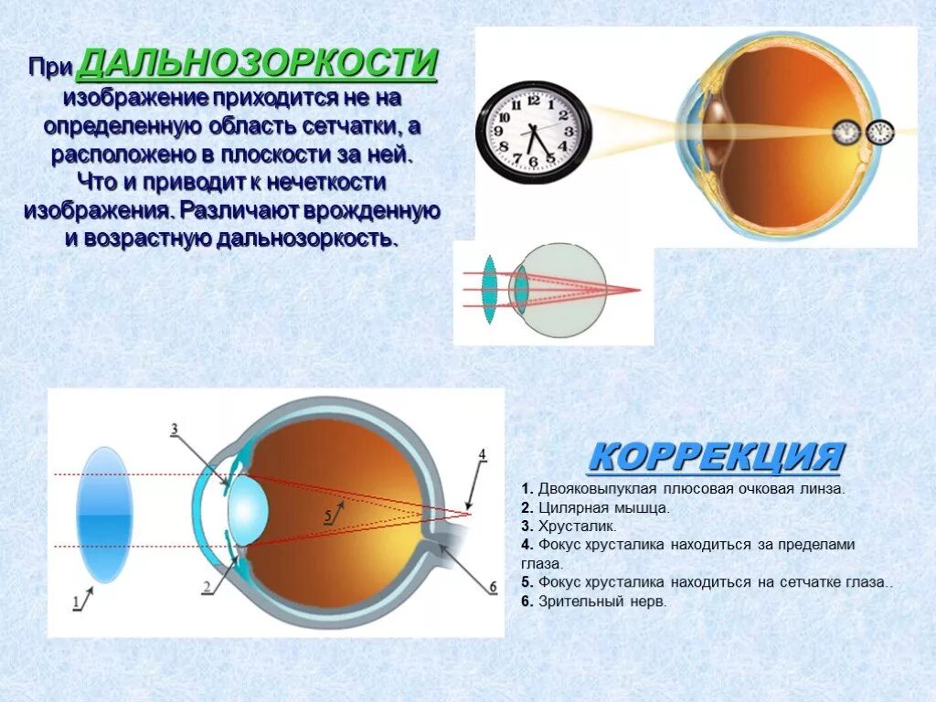 Гиперметропия слабой степени 52.0. Гиперметропия 2 степени. Гиперметропия глаза что это такое у детей. Гиперметропия средней степени обоих глаз.