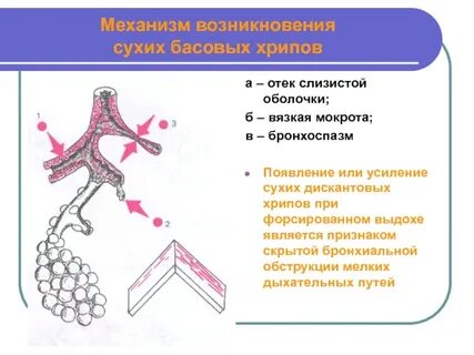 Хрипы без мокроты